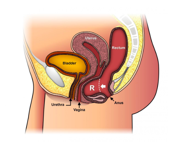 Perineal Descent  Austin Urogynecology