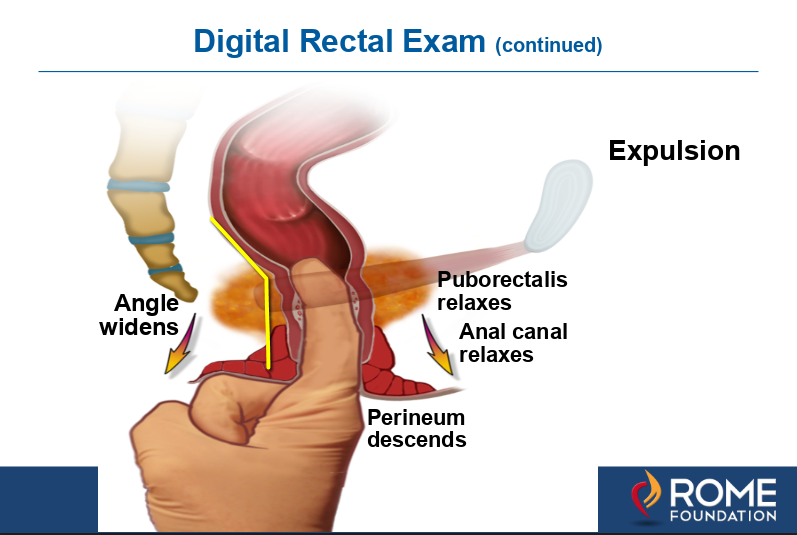 Diagnosing By Rectal Examination Pelvic Floor Dyssynergia And Levator Ani Syndrome April 2019 Drossmancare